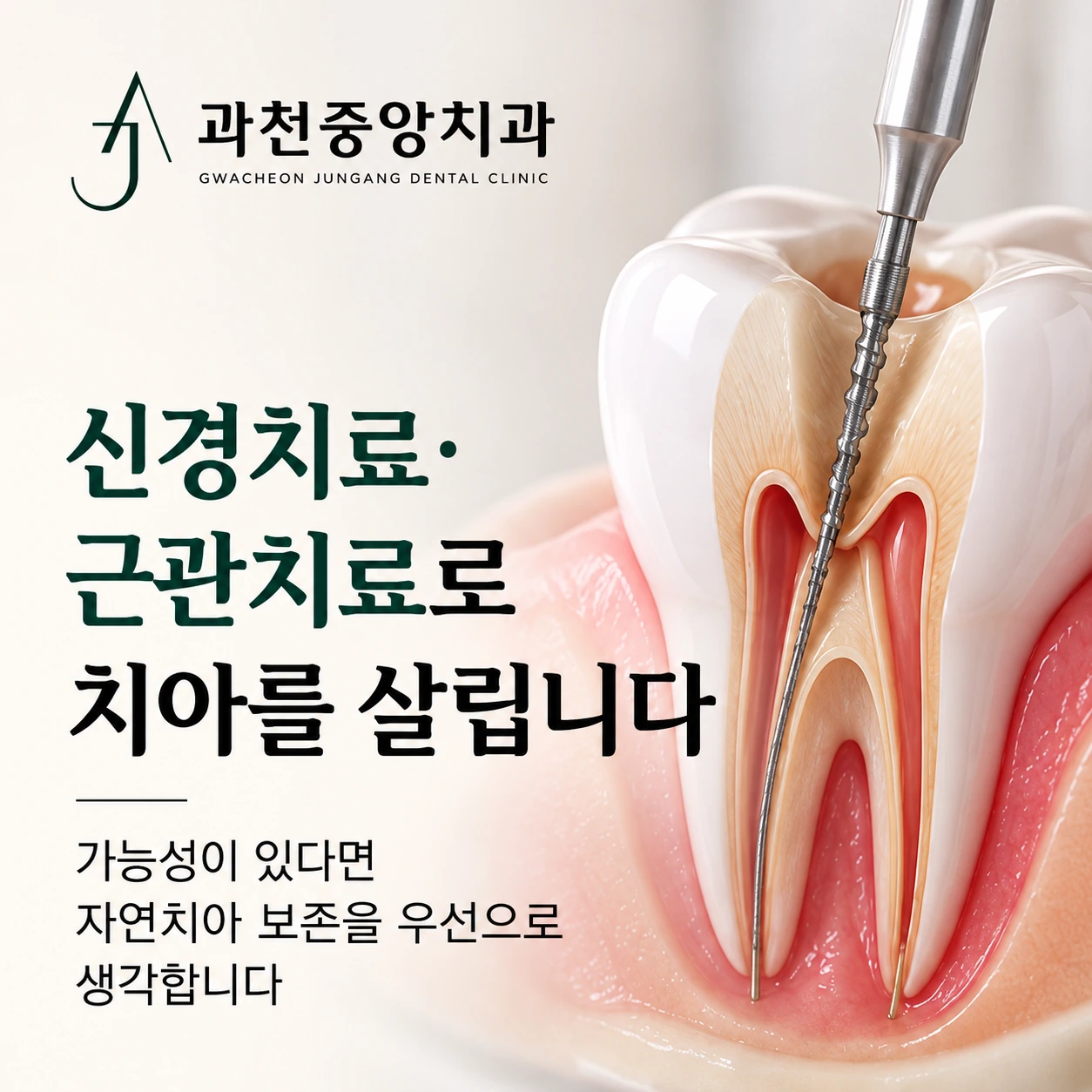 신경치료와 근관치료를 통한 자연치아 보존